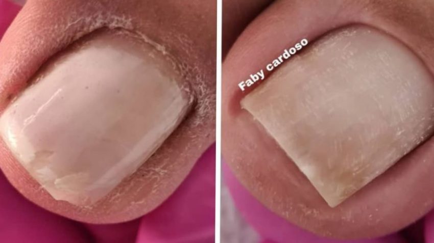 03 Vídeos GRÁTIS  De Cutilagem  Perfeita No Dedão Do Pés