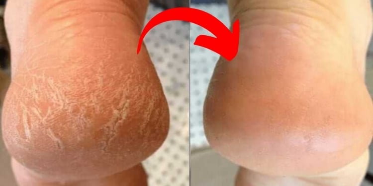 Plástica Nos Pés – Conheça O Sucesso Da Transformação Nos Pés Que As Mulheres Estão Amando